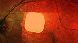 С помощью вживленых микрочипов слабовидящие обретают возможность читать